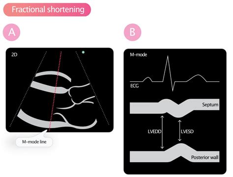 lv segments on echo|what is fractional shortening echo.